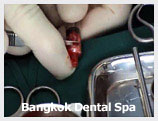 dental implants thailand, dental implants bangkok