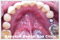 implant dentistry in thailand