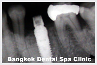 implant dentistry in thailand