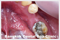 implant dentistry in thailand