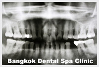 implant dentistry in thailand