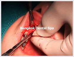 implant dentistry in thailand