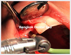 implant thailand