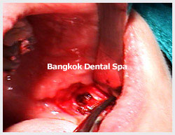 implantsbangkok