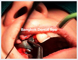 dentalimplantthailand