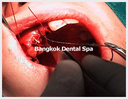 dental implants bangkok