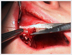 thailand dental implant