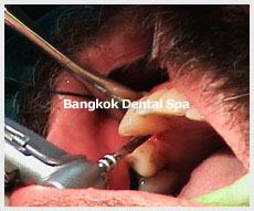 Dental Implants thailand