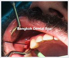 Dental Implants thailand