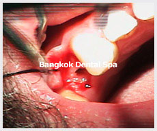 Dental Implants thailand