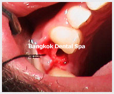 Dental Implants thailand