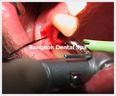 Dental Implants thailand