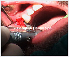 Dental Implants thailand