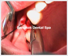 Dental Implants thailand