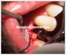 Dental Implants thailand