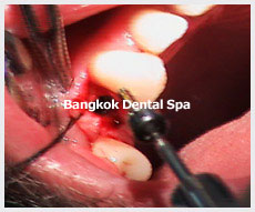 Dental Implants thailand