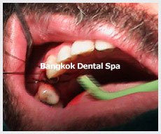 implant dentistry in thailand