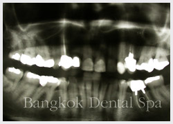 dental implant thailand