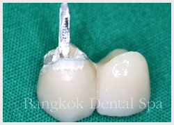 dental implant bangkok