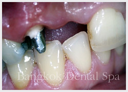 dental implant