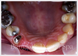 thailand dental implant