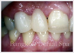 bangkok dental implant